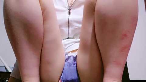 Media: Video of a person's legs in white shorts, with noticeable red marks on the inner thighs, possibly from chafing, set against a white background.