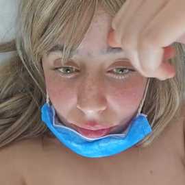 A close-up video of a young woman with light skin and blonde hair, wearing a blue surgical mask, her face marked with redness and irritation, likely from a medical procedure.