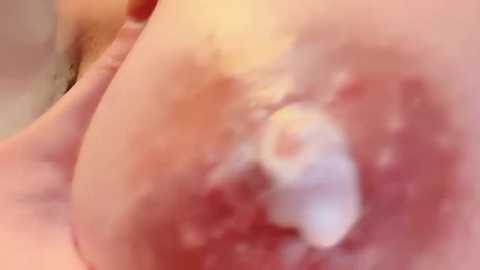 Video of a close-up view of a swollen, reddish-purple, bruised area on a light-skinned person's chest, with visible swelling and discoloration, likely indicating injury or trauma. The background is blurred.