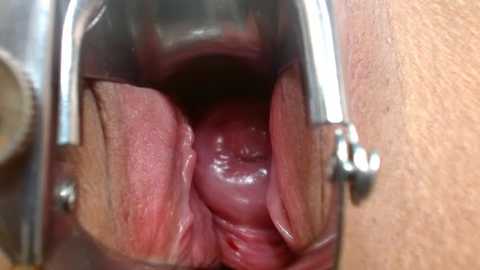 Video of a vaginal canal viewed through a speculum, showing the pinkish-red inner walls and a visible cervix at the center. The background includes a metallic speculum handle.