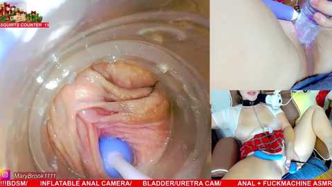 Video of a medical procedure showing a pink, inflamed rectum being cleaned with a blue and white syringe, accompanied by close-up images of the procedure and a woman's face.