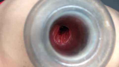 Media: Video of a close-up of a human eye with a dilated pupil, showing the iris, sclera, and red blood vessels.