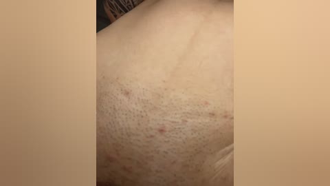 Close-up video of a light-skinned person's back showing visible pores, fine hair, and scattered red bumps, possibly acne or insect bites, against a beige background.