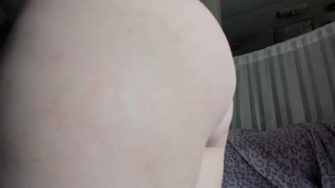 Media: A close-up video of a light-skinned person's buttocks, showing red marks and slight dimpling, taken indoors with white curtains in the background.